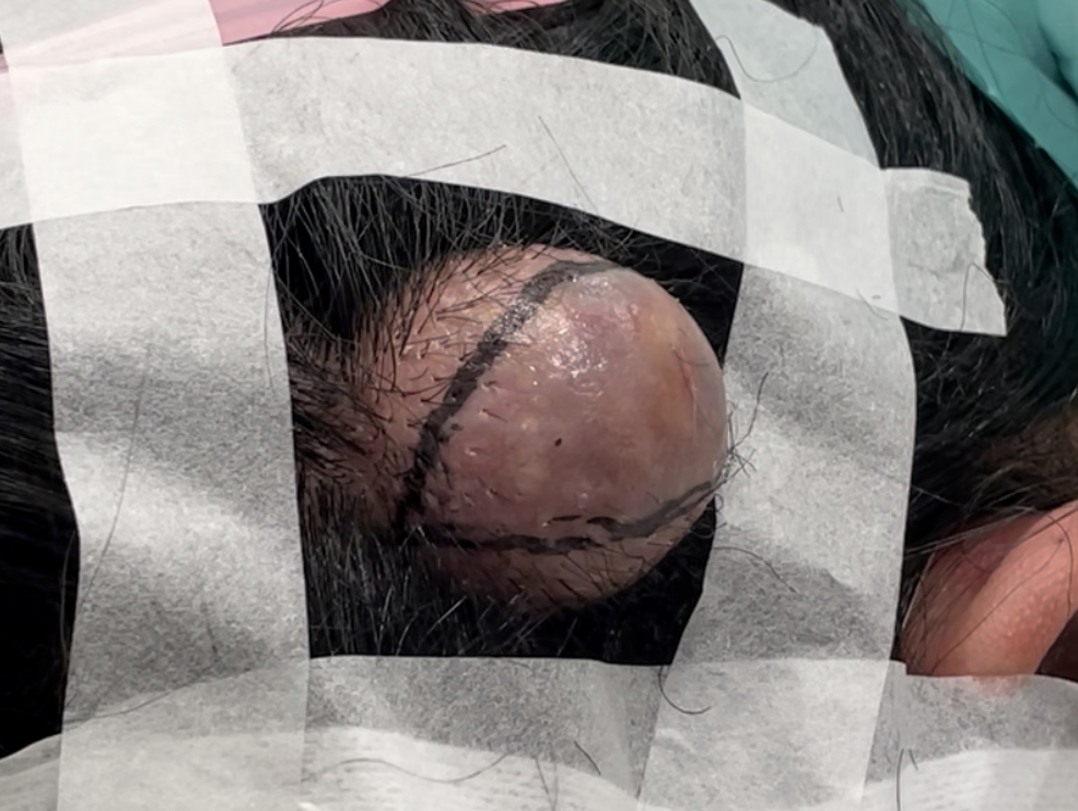 頭部の粉瘤 切開ライン