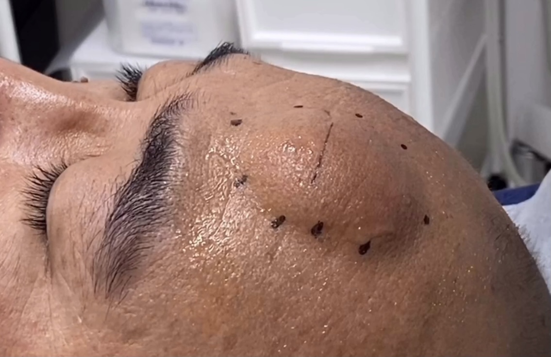 前額部の脂肪腫