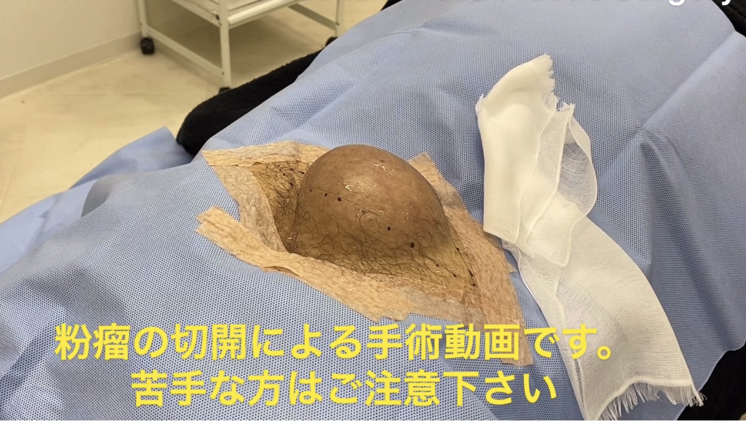 臀部の大きな粉瘤 10cm大