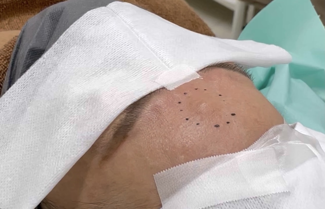 おでこの外骨腫