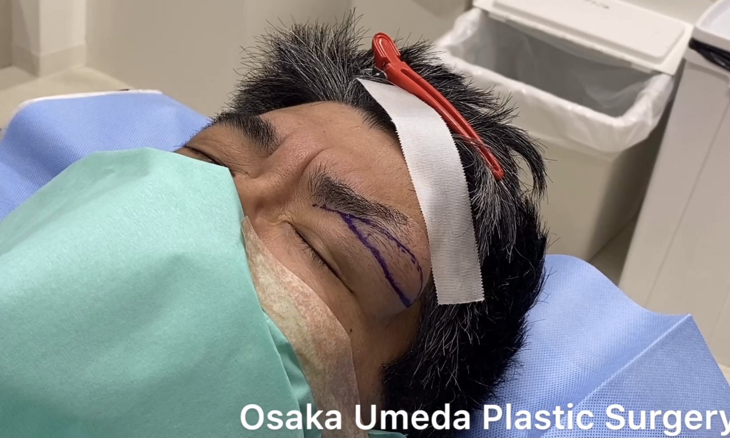 デルモイドシスト dermoid cyst