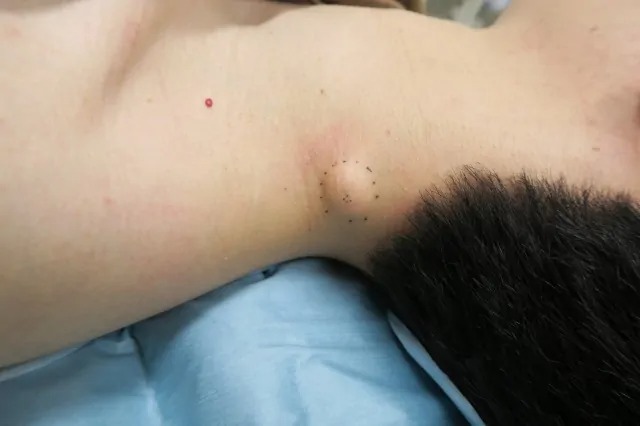 粉瘤(アテローム)治療/治療方法・症例