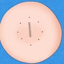 しっかりと止血し、切開部分を縫合します。