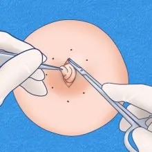 メスで慎重に切開します。