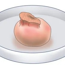 粉瘤をまるごと摘出します。