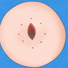 縫合の際に皮膚にシワを作らないよう切開ラインをデザインします。